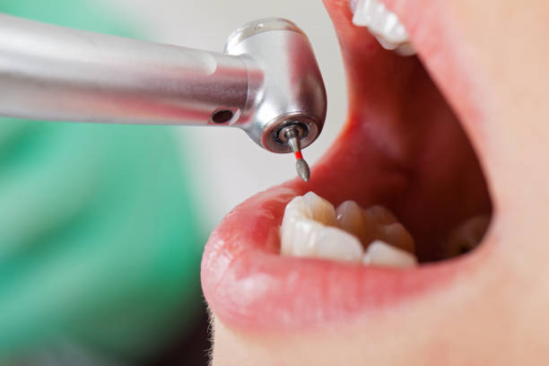 Best Emergency Wisdom Tooth Extraction in Berryville, VA